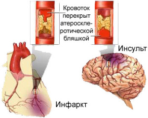 ateroskleroz_sosudov_golovnogo_mozga