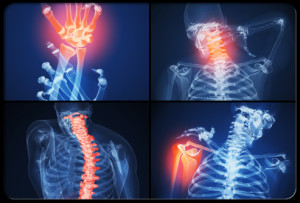 Rheumatoid-Arthritis