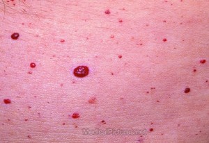 cherry-angiomas-